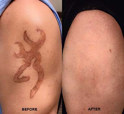 Proper Aftercare Instructions for Laser Tattoo Removal  Rochester Tattoo  Removal