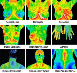Thermography - Digital Infrared Thermal Imaging | Brannick Clinic of Natural Medicine