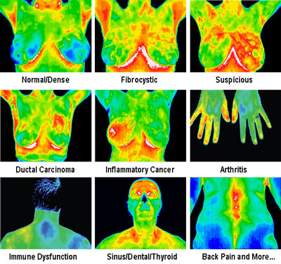 Thermography - Digital Infrared Thermal Imaging | Brannick Clinic of Natural Medicine